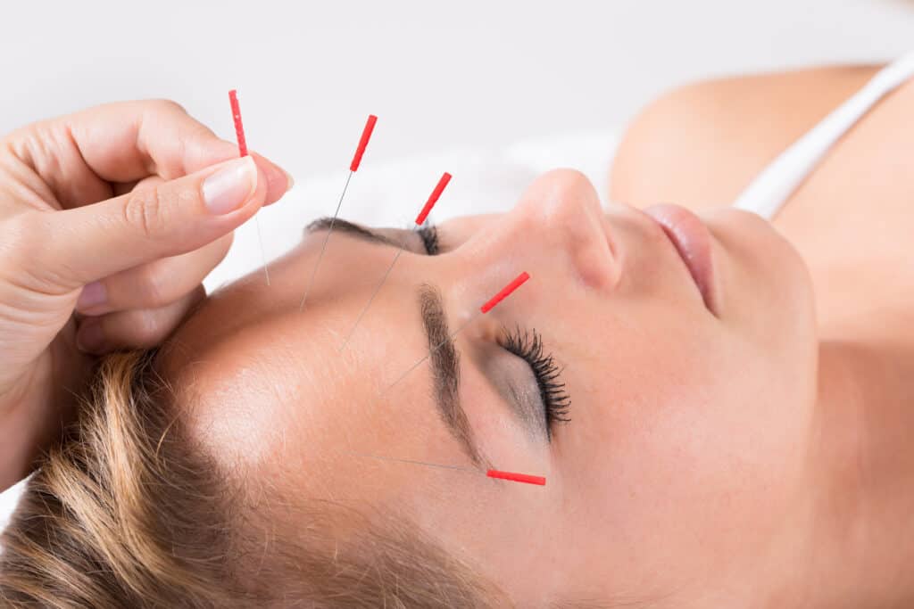 cosmetic acupuncture on the head